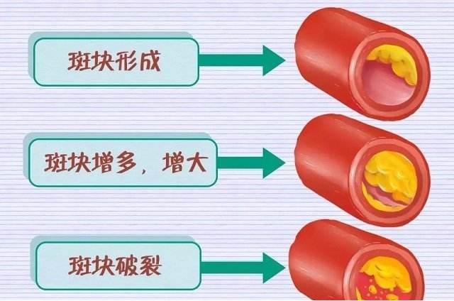 慈能灸石 | 高血脂的“根源”找到了，1个原因常被忽视，试试1物，帮助降血脂